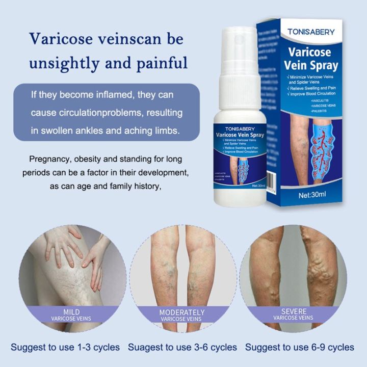 Varicose%20Vein%20Treatment%20Spray%20Vasculitis%20Phlebitis%20Spider%20Relief%20Fatigue%20Leg%20Dilation%20Pain%20Herbal%20Beauty%20Body%20Skin%20Care%2030ml%20-%20Image%204