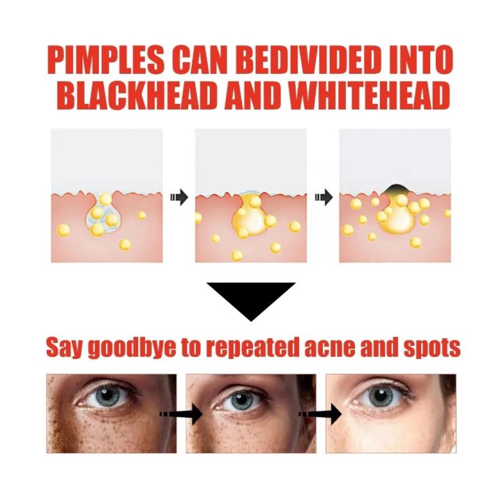 Niacinamida%20Whitening%20Face%20Serum%20Freckles%20Dark%20Spot%20Remover%20Salicylic%20Acid%20Pore%20Shrink%20Moisturizing%20Korean%20Skin%20Care%20Product30ml%20-%20Image%203