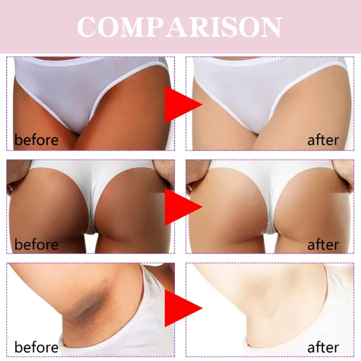 Body%20Whitening%20Cream%20Facial%20Legs%20Bikini%20Sensitive%20Areas%20Whitening%20Brighten%20Skin%20Colour%20Dark%20Spot%20Corrector%20For%20Intimate%20Areas%20-%20Image%203