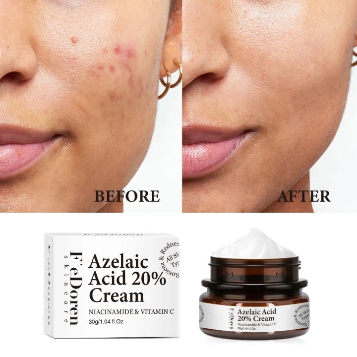 Remove%20Melasma%20Azelaic%20Acid%2020%25%20Whitening%20Fades%20Acne%20Cream%20Freckle%20Dark%20Pigment%20Spots%20Melanin%20Alpha%20Arbutin%20Face%20Cream%20Skin%20Care%20-%20Image%206