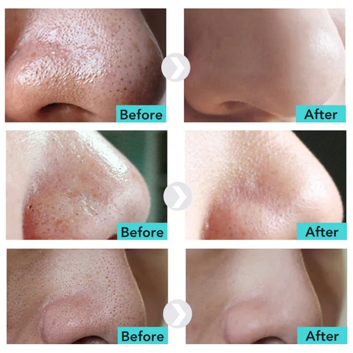 LANBENA%20Blackhead%20Remover%20Cream%20Paper%20Plant%20Pore%20Strips%20Nose%20Acne%20Cleansing%20Black%20Dots%20Peel%20Off%20Mud%20Mask%20Treatments%20Skin%20Care%20-%20Image%203