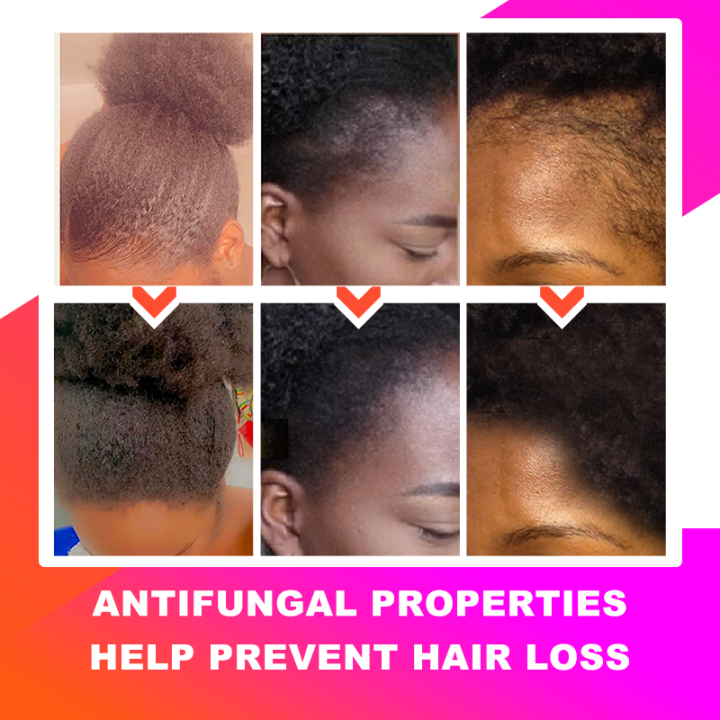 Sevich%20Africa%20Traction%20Alopecia%20Chebe%20Hair%20Thickening%20Set%2030ml%20Hair%20Growth%20Oil%20Fast%20Growing%20100g%20Hair%20Butter%20Strong%20Hair%20Root%20-%20Image%207