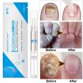 Gentle ingredients skin friendly and no side effect 3ML Fungal Nail Treatment Pen Onychomycosis Paronychia Anti Fungal Nail Infection Chinese Herbal. 