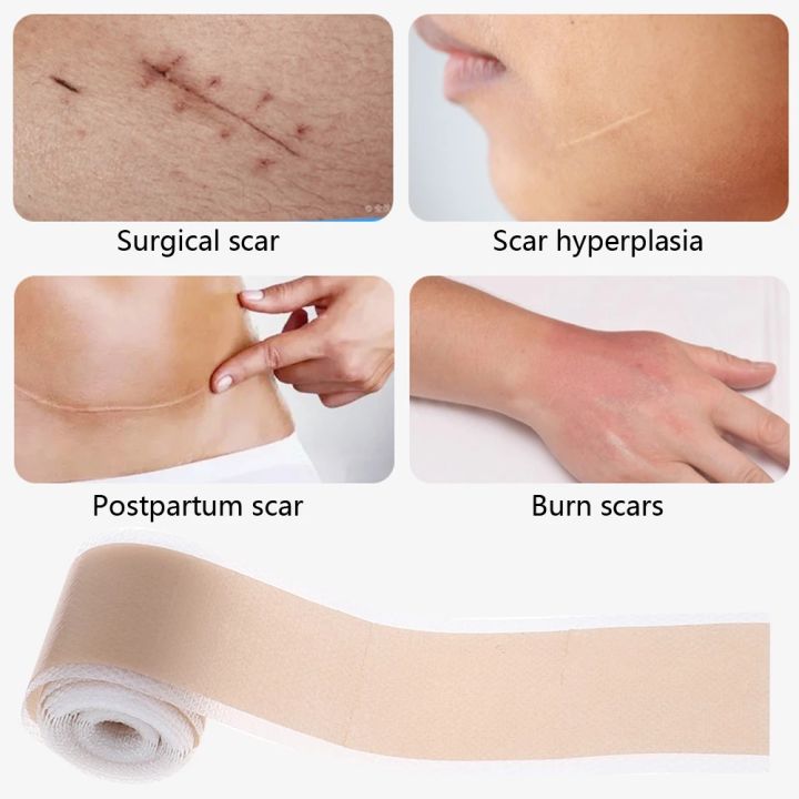 4x50cm%20Silicone%20Gel%20Scar%20Sheet%20Patch%20Treatment%20Removal%20Tape%20Acne%20Trauma%20Burn%20Scar%20Cover%20Skin%20Repair%20Section%20Ear%20Beauty%20-%20Image%202