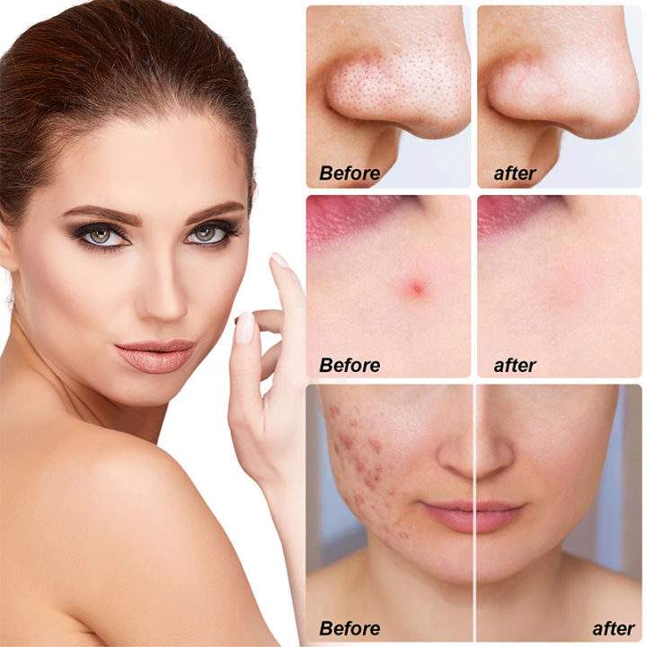 Large%20Hydrocolloid%20Patch%20Acne%20Removal%20Full%20Face%20Pimple%20Patches%20Face%20Cleaning%20Mask%20For%20Nose%20Chin%20Forehead%20Cheek%20Protect%20Skin%20-%20Image%202