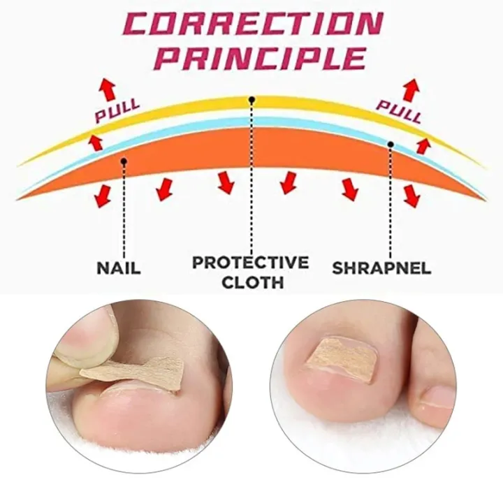 Pexmen%2010/20/50/100Pcs%20Ingrown%20Toenail%20Correction%20Stickers%20Toenail%20Corrector%20Patch%20Keep%20Nails%20Healthy%20Relieve%20Pain%20-%20Image%203