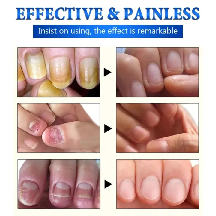 EELHOE%20Makes%20Your%20Nail%20Clean%20EELHOE%20Nail%20Repair%20Serum%20Nail%20Repair%20Oil%2015ML%20-%20Image%207