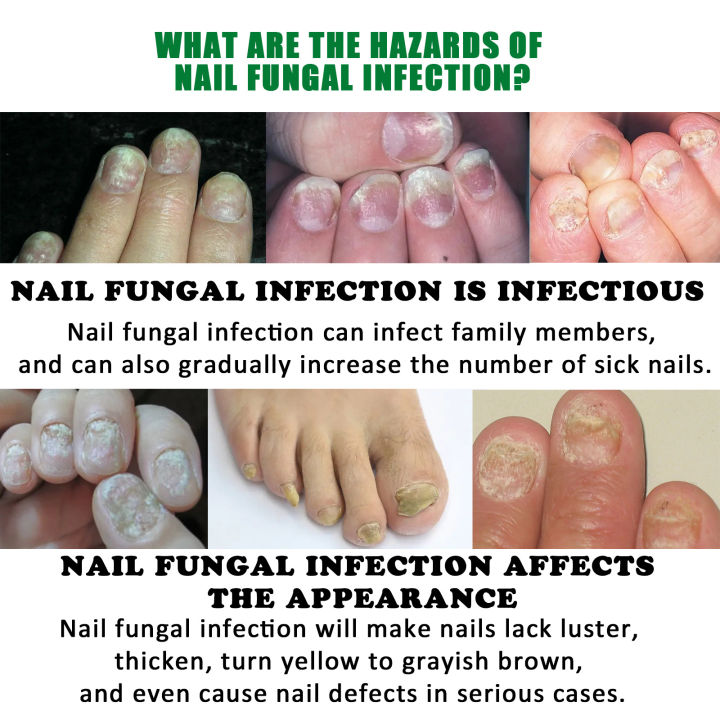 Jaysuing%20Ginger%20Nail%20Treatment%20Moisturizer%20for%20soft%20nails,%20nail%20brightening,%20nail%20fungus,%20nail%20repair,%20hand%20and%20foot%20nails%20-%20Image%204