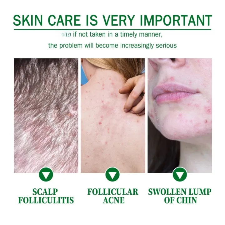 Hair%20Follicle%20Cream%20Treat%20Scalp%20Hair%20Folliculitis%20Skin%20Inflammation%20Cysts%20Papules%20Spot%20Remover%20Body%20Acne%20Anti%20Itching%20Ointment%20-%20Image%202