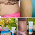 Aichun Beauty Anti-Stretch Marks Cream | Stretch Marks Removal Cream. 