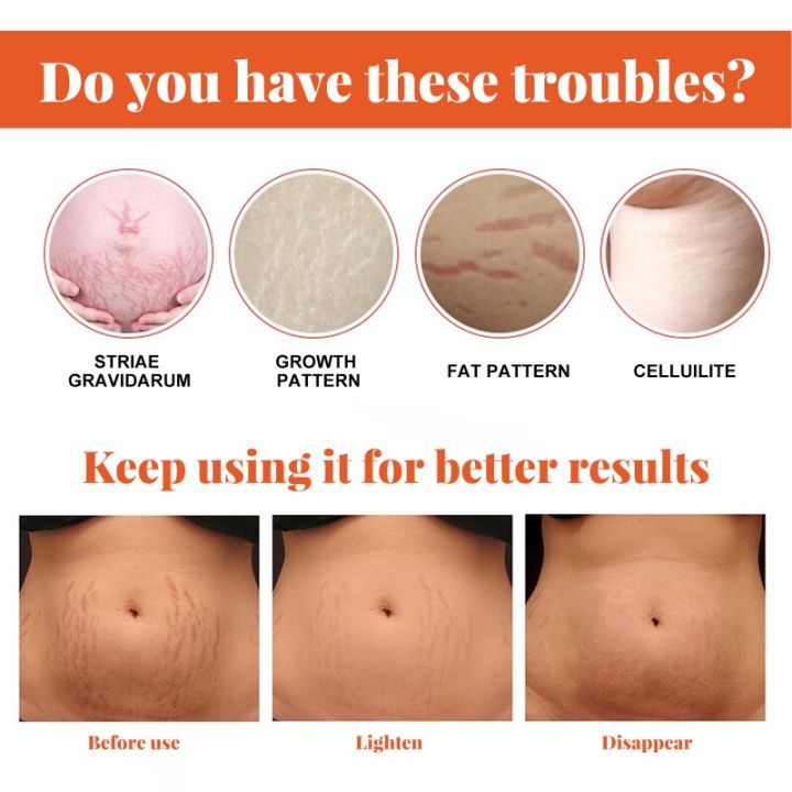 %E3%80%907Rings%20Store%E3%80%91Repair%20Essential%20Oil%20Stretch%20Mark%20Removal%20Removal%20Acne%20Stretch%20Marks%20Fat%20Striae%20Gravidarum%20Oils%2020ml%20-%20Image%204