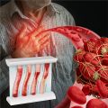 LDL Cholesterol Blood Vessel Model, 4-Stage Vascular Disease Teaching and Training Tool. 
