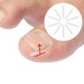10Pieces Ingrown Toenail Corrector Strips Toenail Correction Tool Men. 