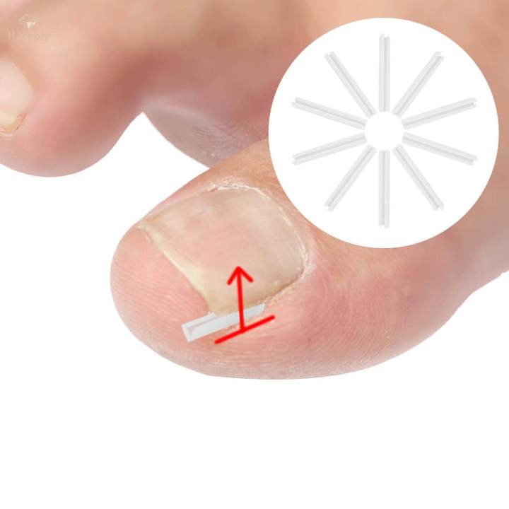 10Pieces%20Ingrown%20Toenail%20Corrector%20Strips%20Toenail%20Correction%20Tool%20Men%20-%20Image%203