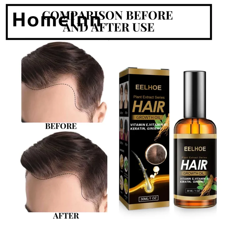 %E3%80%90Good-Love%20Store%E3%80%91(New)%20hair%20essence%20high%20saturation%20anti%20hair%20loss%20essential%20oil%20-%20Image%203