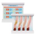 LDL Cholesterol Blood Vessel Model, 4-Stage Vascular Disease Teaching and Training Tool. 