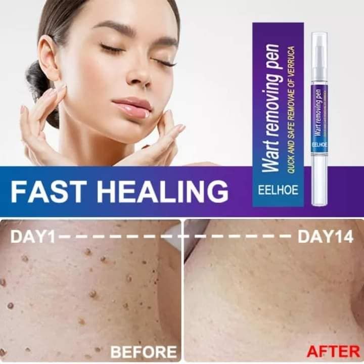 Mollus%20Wart%20Remover%20Liquid%20best%20quality%20pen%20-%20Image%204