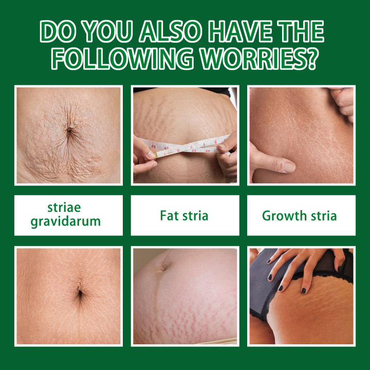 Jaysuing%20Pregnancy%20Repair%20Spray%20Fade%20Pregnant%20Women%20Pregnancy%20Fine%20Lines%20Postpartum%20Skin%20Pregnancy%20Lines%20Care%20Spray%20-%20Image%204