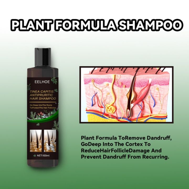 Treatment%20Of%20Psoriatic%20Seborrheic%20Dermatitis%20With%20Anti%20Tinea%20Capitis%20And%20Anti%20Itching%20Shampoo%20Anti%20Dandruff%20And%20Oil%20Control%20Hair%20-%20Image%203
