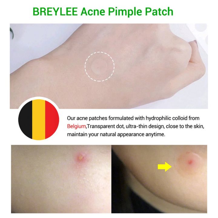 【DIV MALL】Patch Pimple Stickers Pimple Remover Spot Facial Mask