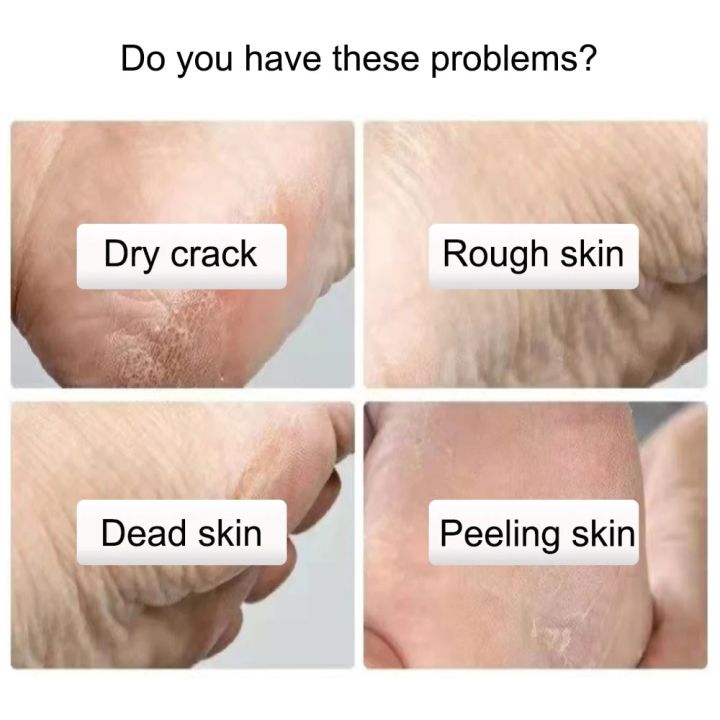 Exfoliating%20Foot%20Peeling%20Mask1%20Pair/2PCS%20Pedicure%20Socks%20Scrub%20For%20Repair%20Dead%20Skin%20Remove%20Peel%20Off%20Care%20Korean%20Cosmetic%2040Ml%20-%20Image%202