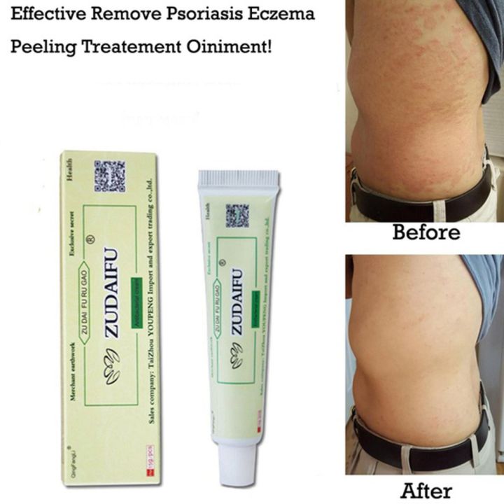 (New)%20zudaifu%20antibacterial%20ointment%20creams%20Psoriasis%20Eczema%20peeling%20herbal%20cream%20beige%20&%20Green%20-%20Image%203