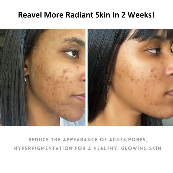 118ml%20Tumeric%20Dark%20Spots%20Toner%20Spots%20Eraser%20Corrector%20Turmeric%20Fade%20Blemishes%20Dark%20Spot%20Remover%20Acne%20Remover%20Toner%20for%20Dark%20Skin%20-%20Image%202