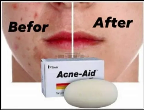 Stiefel%20acne-aid%20-%20100g%20pimple%20prone%20and%20oily%20skin%20soap%20-%20Image%202