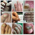 7 Day Nail Fungus Removal Cream Treatment Fungal Toe Nail Repair Gel Anti-infection Paronychia Onychomycosis Foot Care Product For Men/Women. 