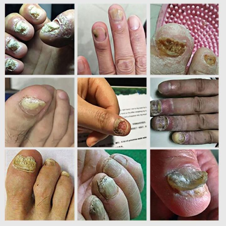 7%20Day%20Nail%20Fungus%20Removal%20Cream%20Treatment%20Fungal%20Toe%20Nail%20Repair%20Gel%20Anti-infection%20Paronychia%20Onychomycosis%20Foot%20Care%20Product%20For%20Men/Women%20-%20Image%202