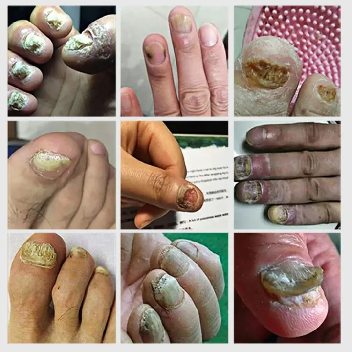 Creme para remoção de fungos nas unhas por 7 dias, gel reparador de fungos nas unhas dos pés, anti-infecção, paroníquia, onicomicose, produto para cuidados com os pés para homens/mulheres