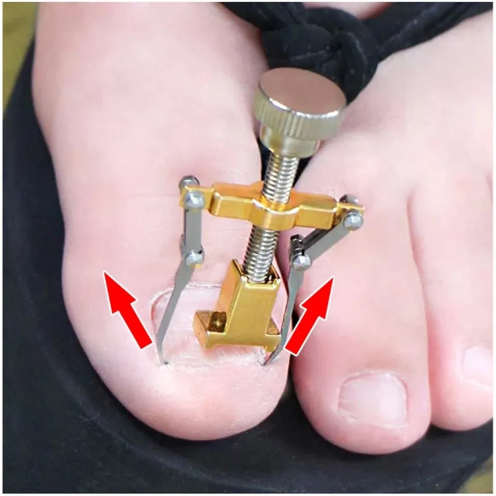 Details%20about%20New%20Pro%20Ingrown%20Toe%20Nail%20Recover%20Toenail%20Correction%20Pedicure%20Fixer%20-%20Image%202