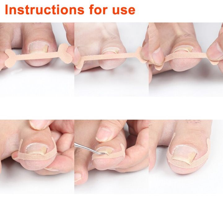 20-100pcs%20Professional%20Ingrown%20Toenail%20Foot%20Corrector%20Stickers%20Elasticity%20Toe%20Nail%20Care%20Pedicure%20Tools%20Toe%20Health%20Care%20Protects%20-%20Image%204