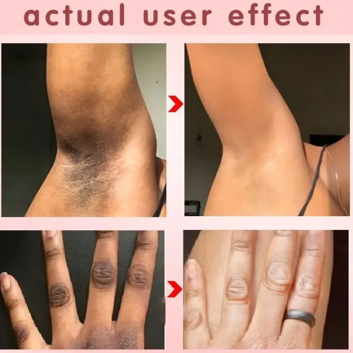 Body%20Whitening%20Cream%20Fast%20Bleach%20Private%20Parts%20Lighten%20Underarm%20Legs%20Knees%20Melanin%20Intimate%20Areas%20Remove%20Dark%20Spot%20Beauty%20Health%20-%20Image%202