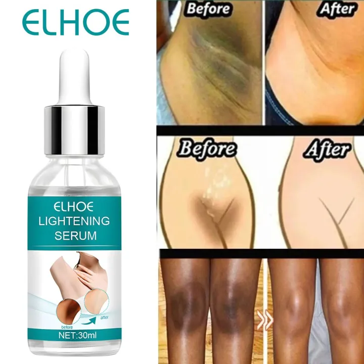 EELHOE%20Makes%20Brighter%20To%20Your%20Body%20And%20Posture%20Without%20Any%20Side%20Effect%20-%20Image%205
