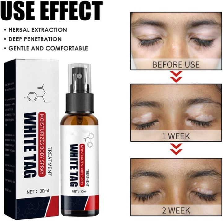 White%20Tag%20Spray%20For%20Vitiligo,%20Psoriasis,%20Leukoplakia%20-%20Reduces%20White%20Spots%20on%20Skin%20and%20Improve%20Skin%20Pigmentation%20Treatment%20Moisturizing%20Body%20Spray%20No%20Side%20Effect%20-%20Image%203