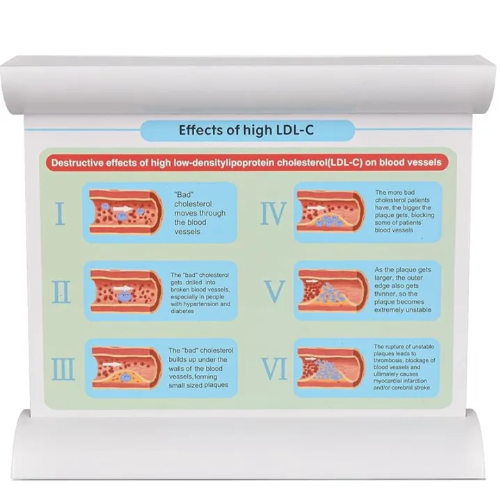 LDL%20Cholesterol%20Blood%20Vessel%20Model,%204-Stage%20Vascular%20Disease%20Teaching%20and%20Training%20Tool%20-%20Image%205