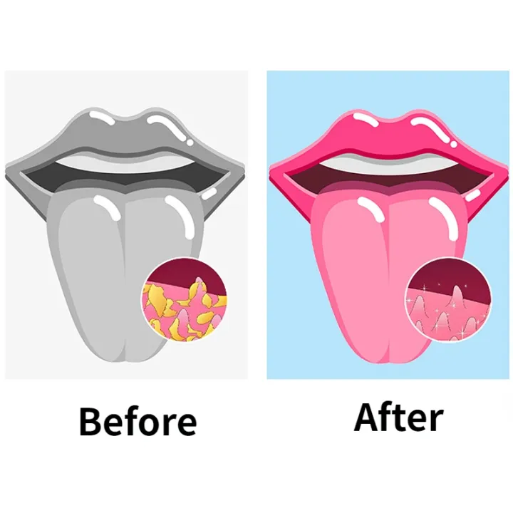 Tongue%20Scraper%20and%20Coating%20Cleaning%20Gel%20Fresh%20Remove%20Odor%20To%20Cleaner%20for%20Bad%20Breath%20Cleaning%20Products%20for%20Tongue%20Cleaning%20-%20Image%205