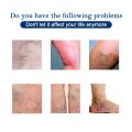 Varicose Vein Treatment Spray Vasculitis Phlebitis Spider Relief Fatigue Leg Dilation Pain Herbal Beauty Body Skin Care 30ml. 