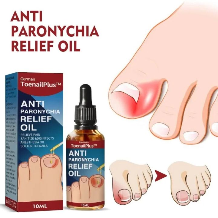100%-original】 Anti Paronychia Relief Oil Ingrown Toenail Drops - Main Image
