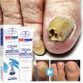 7 Day Nail Fungus Removal Cream Treatment Fungal Toe Nail Repair Gel Anti-infection Paronychia Onychomycosis Foot Care Product For Men/Women. 