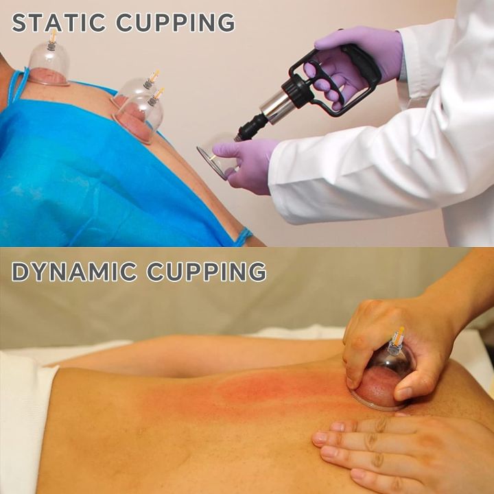 Hijama/%20Cupping/%20Sunnah%20Therapy%201%20Set%20with%2012pcs%20Cup%20-%20Image%207