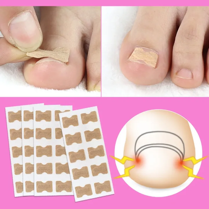 Ingrown%20Toenail%20Corrector%20Stickers%20Paronychia%20Treatment%20Pedicure%20Toe%20Nail%20Care%20Corrector%20Patch%20Correction%20Stickers%2010-50Pcs%20-%20Image%203