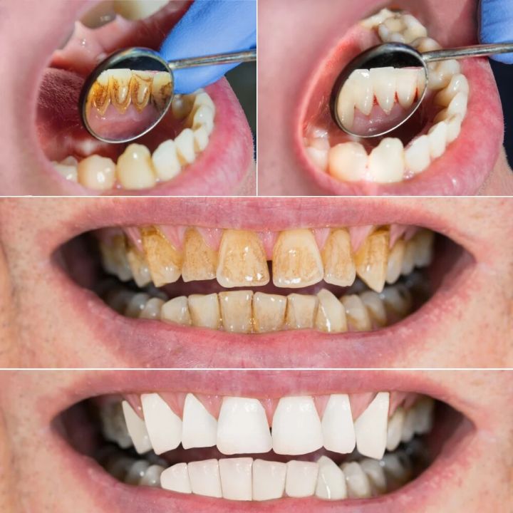 Ultrasonic%20Tooth%20Cleaner%20Electric%20Tooth%20Brush%20Tartar%20Eliminator%20Scraper%20Cleaner%20Dental%20Scaler%20Calculus%20Stone%20Plaque%20Remover%20-%20Image%206