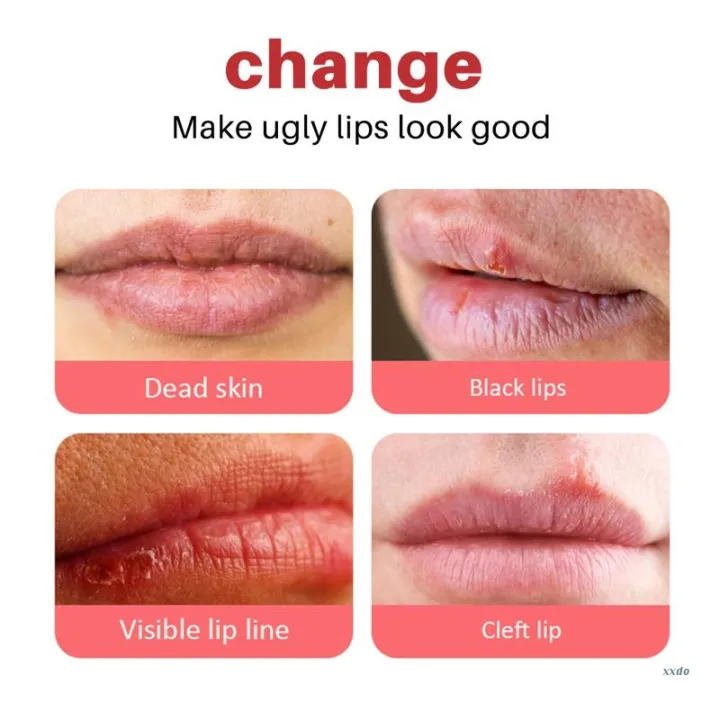 Lip%20Black%20Removal%20Lip%20Balm%20Eliminates%20Uneven%20Dark%20Spots%20on%20the%20Lips%20Treatment%20-%20Image%203