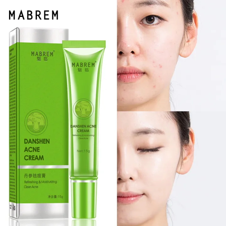 Danshen%20Acne%20Cream%20Acne%20Removal%20Fades%20Acne%20Marks%20Repair%20Damaged%20Skin%20Gentle%20Non-Irritant%20Skin%20Rejuvenating%20Nourishing%20Skin%20Care%20-%20Image%202