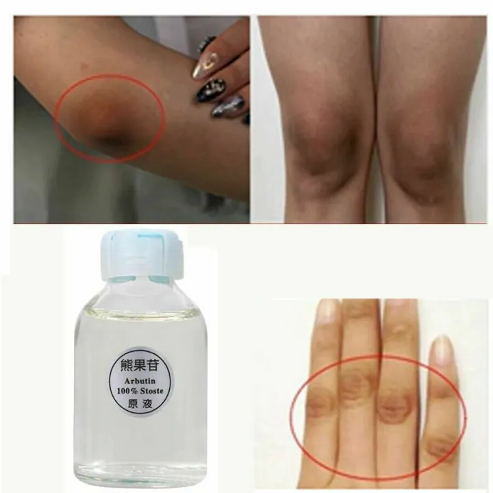 30ml%20Dark%20Skin%20Permanent%20Whitening%20Lightening%20Brightening%20Bleaching%20Kojic%20Acid%20Serum%20Face%20Skin%20Best%20Choose%20-%20Image%202