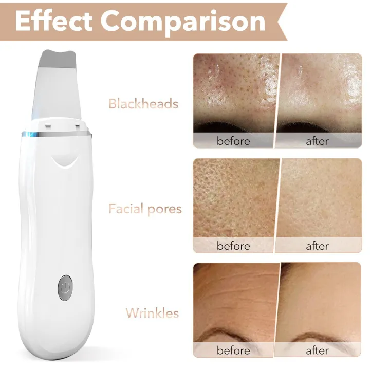 Ultrasonic%20Skin%20Scrubber%20Pore%20Cleaner%202+4%20Kit%20Facial%20Ion%20Shovel%20Deep%20Face%20Cleaning%20Sonic%20Peeling%20Device%20Kit%20Blackhead%20Remover%20-%20Image%206