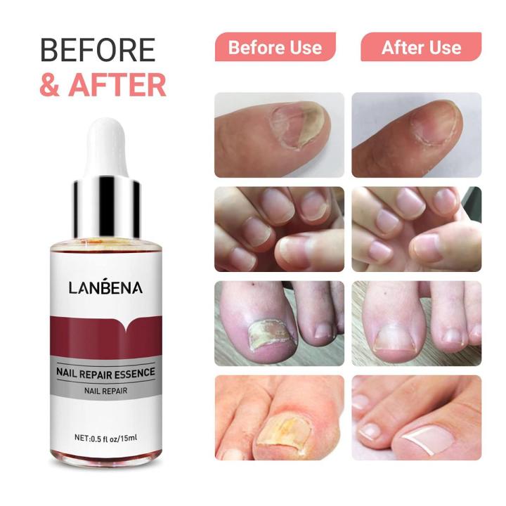 LANBENA Nail Repair Essence Serum - 12ml | Daraz.com.bd
