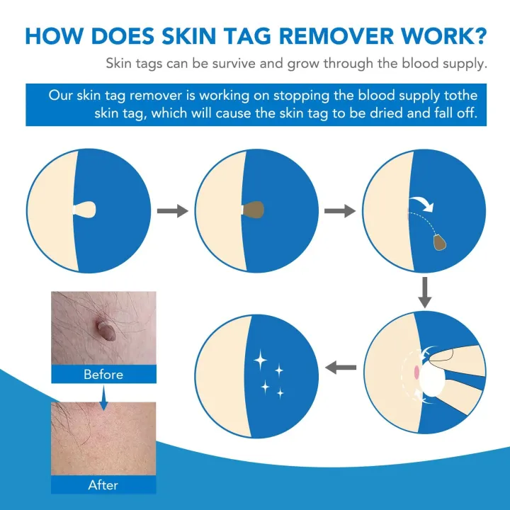 Skin%20Tag%20Removal%20Kit%20Home%20Mole%20Wart%20Puntos%20Negros%20Remover%20Equipment%20Micro%20Skin%20Tag%20Removeal%20Tool%20Easy%20To%20Clean%20Skin%20Care%20Tool%20-%20Image%204